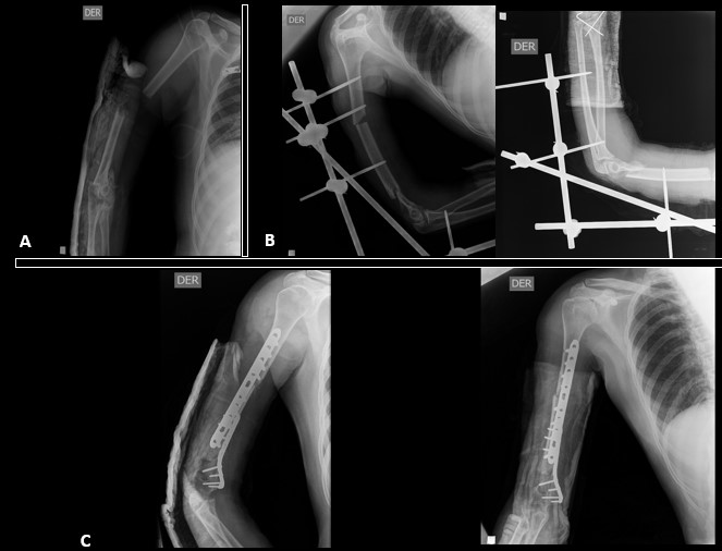 Polytrauma with humerus fracture. A.Admission X-ray of right humerus fractureB. X-ray of the humerus after damage control with external fixatorC.Definitive fixation after a second surgical time.