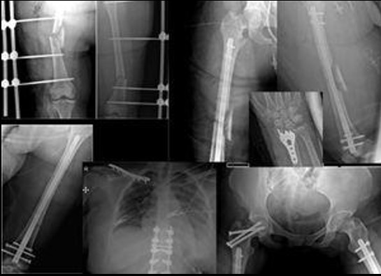 Differences between NISS and ISS calculation in polytraumatized patients. Patients with polytrauma of the chest, abdomen, extremities, pelvis, and spine. Bilateral open femur fracture (5 points), unstable pelvic and radius fracture (4 points), chest trauma and thoracic spine fracture (4 points), and abdominal trauma with stable pneumoperitoneum (2 points). ISS = 52+ 42+ 22= 45 points. NISS = 52+ 42+ 42= 57 points.