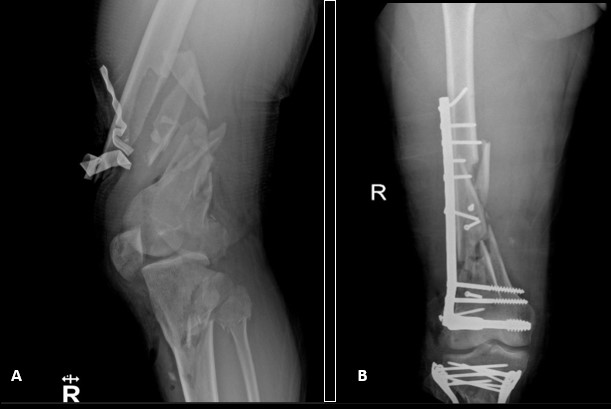 Orthopedic management of a hemodynamically stable patient with polytrauma. A 30-year-old male was admitted for a traffic accident as a motorcycle driver. ISS 30 NISS 32 upon admissionA.Admission X-ray femur shaft fracture + tibial plateau and fibula fractureB.First stage postsurgical result after definitive early stabilization of the fractures