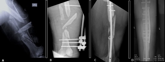  Orthopedic management of a hemodynamically unstable patient with polytrauma. A 30-year-old patient who was involved in a motorcycle accident, upon admission ISS 37 NISS 45 A. Admission radiograph of the left femur with open diaphyseal fracture B. After damage control radiography with external fixator C. Second surgical time 10 days later to admission with retrograde cephalic medullary nail D. 2 years after internal fixation in which adequate consolidation is observed.