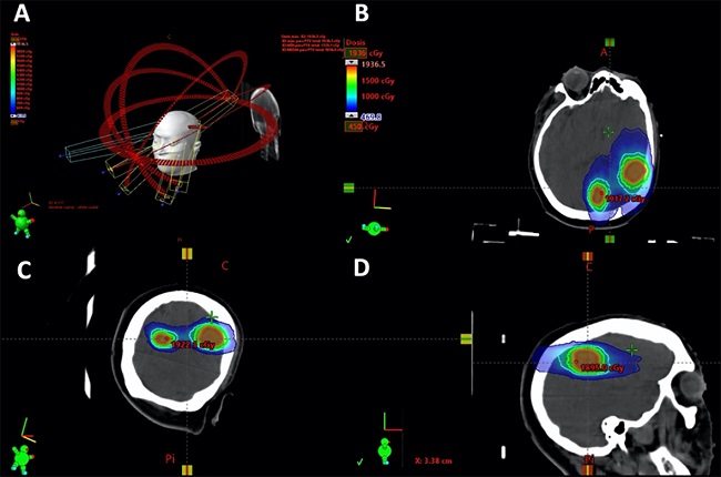 Planning example of a patient with two brain metastases, treated with 18 Gy. The images B, C and D, represent the axial, coronal and sagittal plane rotations respectively. Red PTV outline, green 12 Gy isodose, light blue 9 Gy isodose and dark blue 4.5 Gy. The 18 Gy isodose is not shown since it practically coincides with the PTV outline and would otherwise hinder viewing. 