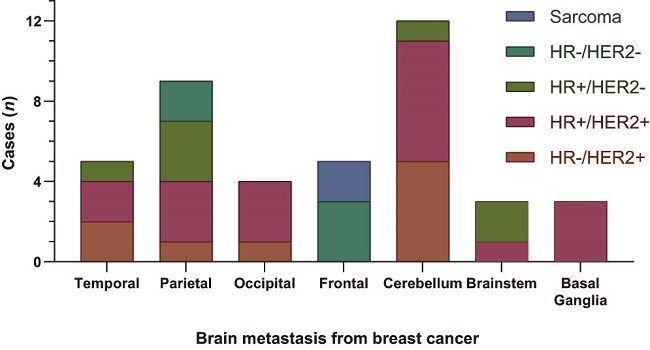 Distribution of BMs from BC treated by VMAT-RS in the central nervous system. Stratifying BMs by the histology and molecular subtypes of the breast cancer.