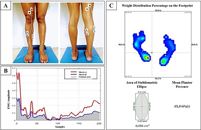 (A) Placement of the electrodes: front (TA, S, and FB muscles) and back (GM, GL, and VM muscles). (B) Area of the muscle coactivation percentage. (C) Baropodometric variables (weight distribution, area of the stabilometric ellipse, and mean plantar pressure).