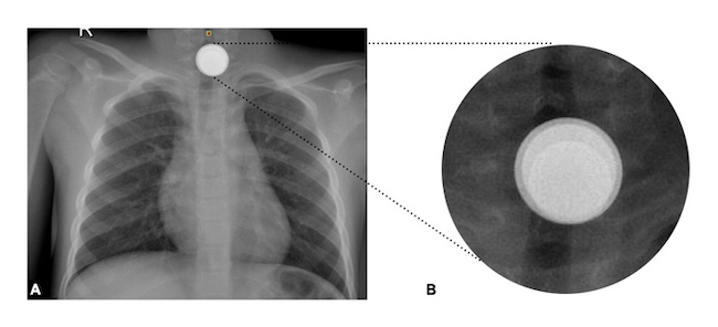 (A) Foreign body in the upper third of the esophagus with an apparent double-ring o halo image. (B) Radiological magnification shows the superimposition of 3 circumferential foreign bodies of different sizes.