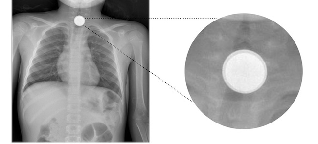 Radiography after the expulsion of a one-euro cent coin. Persistence of two superimposed foreign bodies.