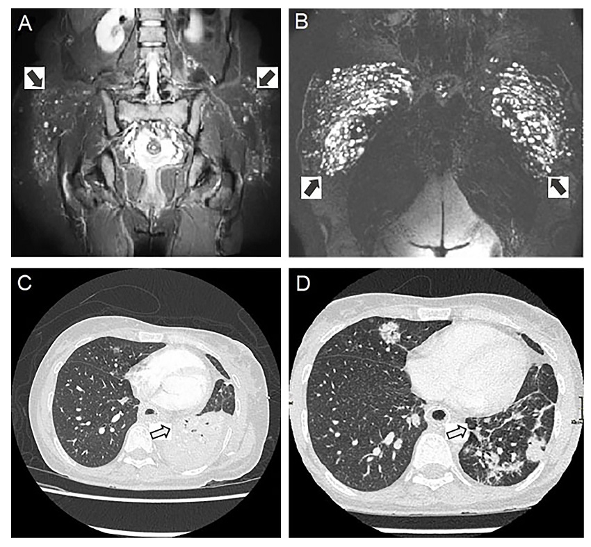 A. Pelvic MRI, coronal view, proton density fat saturation sequence showing hyperintense nodules in subcutaneous cellular tissue. B. STIR sequence showing enhancement of foreign material (biopolymer) with perilesional inflammation and foreign body reaction. C. Chest CT showing inflammatory changes in the mediastinum, occupation by a hypodense material in the left main bronchus extending into the lower lobe, and necrotizing pneumonia. D. Resolution of the obstruction of the left main bronchus, improvement of interstitial changes and consolidation in lung parenchyma with respect to C.