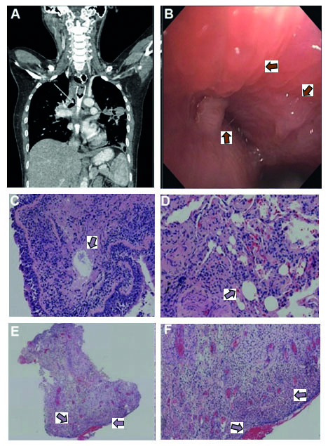 A. Chest CT coronal view showing compromise with severe esophageal stenosis of the stent and occupation of hyperdense material in the mediastinum with involvement of main bronchi and total obstruction of the left main bronchus. B. Endobronchial fiberoptic bronchoscopy view left the main bronchus occluded by an extrinsic occlusion, right main bronchus with protruding hyaline lesion. C, D. 10x and 20x magnification, respectively, hematoxylin and eosin (H&E) staining, transbronchial biopsy, showing bronchial mucosa from the right upper lobe and lung parenchyma and respiratory bronchial epithelium with chronic mononuclear inflammation in the stroma and presence of foreign refractive material; at higher magnification, pulmonary parenchyma with architectural distortion is observed due to the fact of round refractive material. E, F. 4x and 10x magnification, respectively, H&E staining, resection of right main bronchus lesion, granulation tissue with vascular neoformation, presence of acute inflammatory polymorphonuclear infiltrate in moderate quantity, with ulceration of the superficial epithelium. No refractive material is observed. No granulomas or microorganisms are observed.