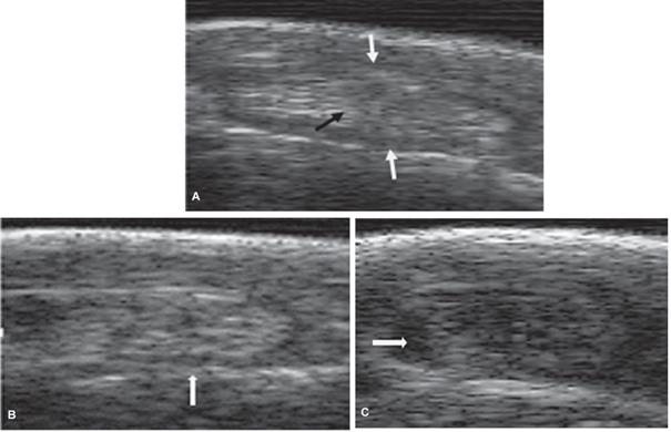 Ultrasound images (linear 8.0 MHZ ultrasonic transducer with coupling) of LDE tendon and synovial sheath where it crosses the lateral border of the tarsus in a CCH. A) Transverse ultrasonographic image of a normal LDE tendon (black arrow) and its synovial sheath (white arrows). B) Transverse ultrasonographic image of an abnormal LDE tendon of tarsus hyperflexion, showing adhesions between the tendon and the synovial sheath (white arrow). C) Transverse ultrasonographic image of an abnormal tarsus (hyperflexion) showing liquids between the synovial sheath and the LDE tendon (white arrow).