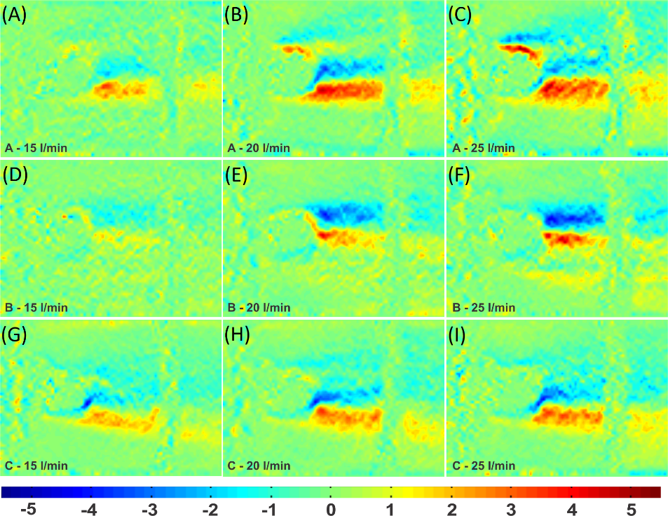 Viscous shear stress in the porcine valve.