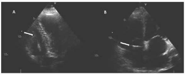 Ecocardiograma bidimensional en vista apical de 4 cámaras; puede observarse la punta del biótomo (flecha blanca) en la imagen A. a punto de tomas la biopsia en la pared libre del ventrículo derecho; y en la imagen B. antes de cruzar el plano tricuspídeo.