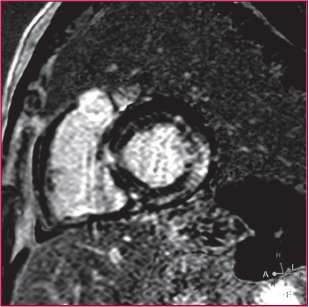 Secuencia de realce tardío a los 10 minutos de la administración de gadolinio, realizada en ritmo de fibrilación auricular. Se observa intenso realce intramiocárdico y subepicárdico (zonas hiperintensas) enel miocardio basal (patrón no isquémico). 
