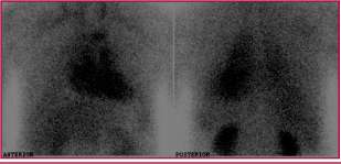 Gammagrafía miocárdica con 99 mticpirofosfato/SPECT con intensa captación por parte del miocardio, compatible con depósitos de amiloide.