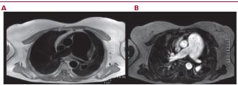 AngioRMN. Corte axial a nivel de la bifurcación de la arteria pulmonar. A: sin gadolinio B: con gadolinio