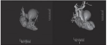 AngioRMN con reconstrucción tridimensional a nivel de la arteria pulmonar.