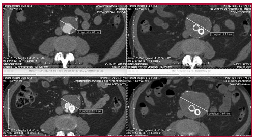 Fig. 1. Im&aacute;genes de tomograf&iacute;a en seguimiento: se evidencia crecimiento del saco aneurism&aacute;tico desde A (preoperatoria, a&ntilde;o 2010,) hasta D (a&ntilde;o 2018).