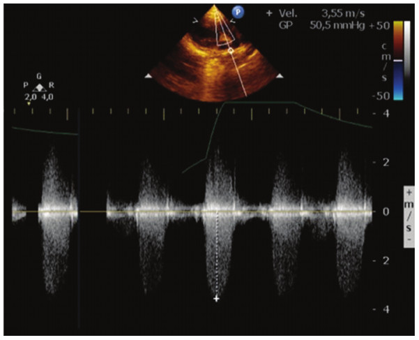 Ecocardiograma Doppler color preoperatorio evidenciando estenosis valvular y subvalvular pulmonar moderada