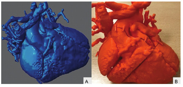 A) Vista anterior de im�gen virtual reconstruida 3D del &ldquo;pool&rdquo; de sangre que se utiliz� para crear la impresi�n tridimensional. B) Vista anterior del modelo 3D impreso mediante m�todo de modelo de dep�sito por fusion (FDM), impresa en 4 segmentos para tener acceso intracard�aco.
