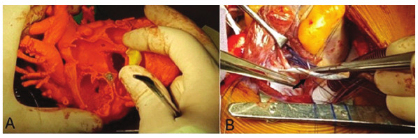 Comparaci�n intraoperatoria entre modelo 3D (A) y anatom�a del paciente. Sutura del parche intracard�aco para crear el tunel (B).