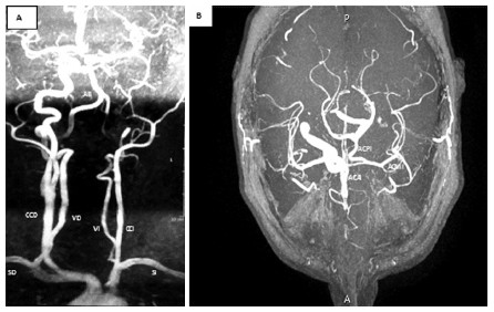 Fig. 2. Angioresonancia Magn�tica Nuclear