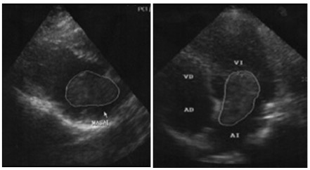 Fig. 1 A. Ecocardiograma con imagen tumoral