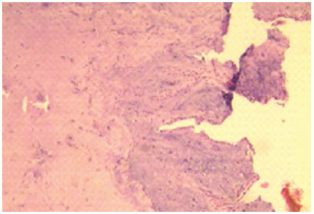 Fig. 1 B. Anatomia patológica compatible con Mixoma