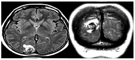 Fig. 2. RMN de cerebro con lesiones córtico y subcorticales