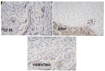 Fig. 3. Inmunomarcación de tejido metastásico compatible con Mixoma