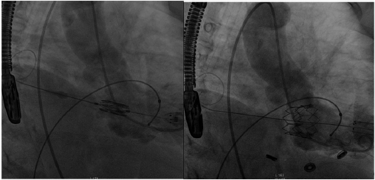 Fluoroscopia con v&aacute;lvula SAPIEN XT en posici&oacute;n mitral antes de su liberaci&oacute;n (izq.) y posteriormente a esta (der.).