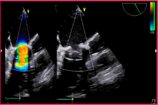 V&aacute;lvula SAPIEN XT en posici&oacute;n mitral, evaluaci&oacute;n ecocardiogr&aacute;fica transesof&aacute;gica con Doppler (izq.) y sin Doppler (der.).