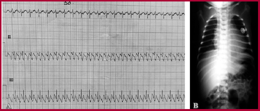 A. ECG: Demuestra un aleteo auricular con conducci&oacute;n 2:1, n&oacute;tese el t&iacute;pico patr&oacute;n de las ondas P en &ldquo;dientes de sierra&rdquo;. B. Teleradiograf&iacute;a de t&oacute;rax: El &iacute;ndice cardiotor&aacute;cico fue del 63%, lo que indica una cardiomegalia leve.