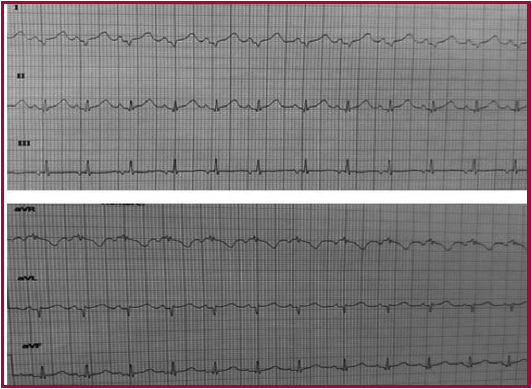 ECG: En ritmo sinusal luego de la segunda cardioversi&oacute;n el&eacute;ctrica.