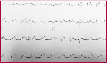 Electrocardiograma tomado a las 3 horas de inicio del dolor torácico, donde se evidencia un ritmo auricular bajo y corriente de lesión subepicárdica en pared inferior
