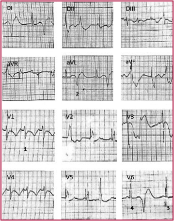 ECG que muestra ritmo MCP que alterna con ritmo propio sinusal (1), con imagen de bloqueo completo de rama izquierda, a una FC de 75 lpm, EV polimorfas con fenómeno de R sobre T (2), fenómenos de fusión (3), pseudofusión (4) y prolongación del QT (QTc de 671)