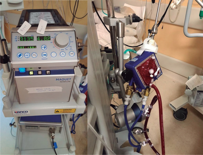 ECMO utilizado durante el tratamiento del paciente