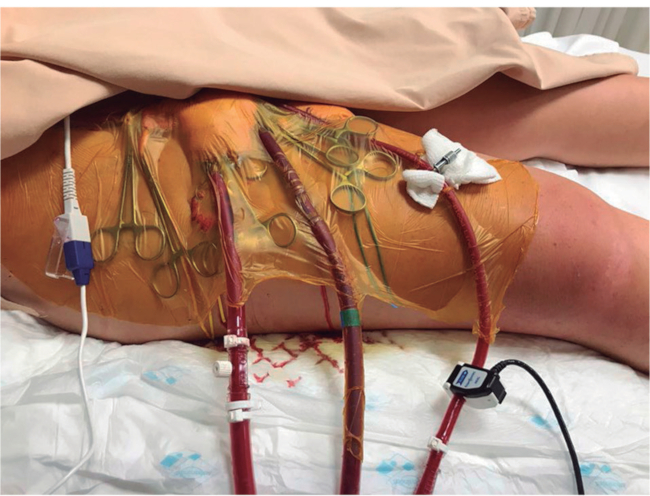 Conexi&oacute;n del ECMO a la paciente