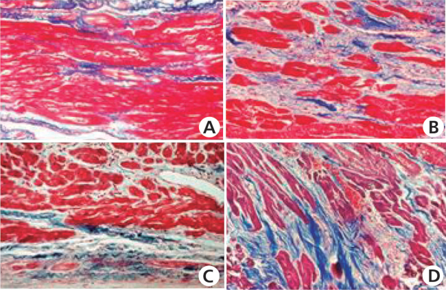 Secciones de diferentes zonas de cortes seriados de aneurisma ventricular chag&aacute;sico. A. Tractos gruesos, separados por escasa cantidad de tejido conectivo (azul), donde alternan fibras con diversos grados de da&ntilde;o celular. B. Alternancia de fibras atr&oacute;ficas, separadas por tejido conectivo laxo (azul) y fibras alineadas en fasc&iacute;culos finos, sugestivos de formar parte de circuitos de reentrada. El espesor de las fibras era de 4,5 a 56,6 &micro;m. C. &ldquo;Islas&rdquo; en &aacute;reas subendoc&aacute;rdicas, con miocardio relativamente conservado, separado por tejido conectivo (parte superior) y c&eacute;lulas de Purkinje pertenecientes a la rama izquierda del haz de His, interrumpida por tejido col&aacute;geno (parte inferior). D. Corte longitudinal de fibras atr&oacute;ficas. Tricr&oacute;mico de Mallory. A y B: 400X, C: 200X y D: X100.