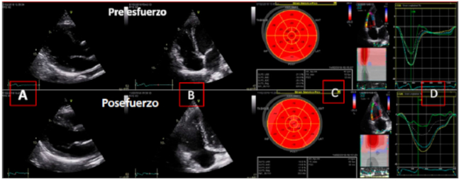 Ecocardiogram basal y posesfuerzo. A. Eje largo paraesternal izquierdo basal y posesfuerzo. B. Eje de cuatro c&aacute;maras apical focalizado en Vd. C. Bull eye de strain longitudinal global basal y posesfuerzo. D. curva de strain de la pared libre del Vd basal y posesfuerzo.