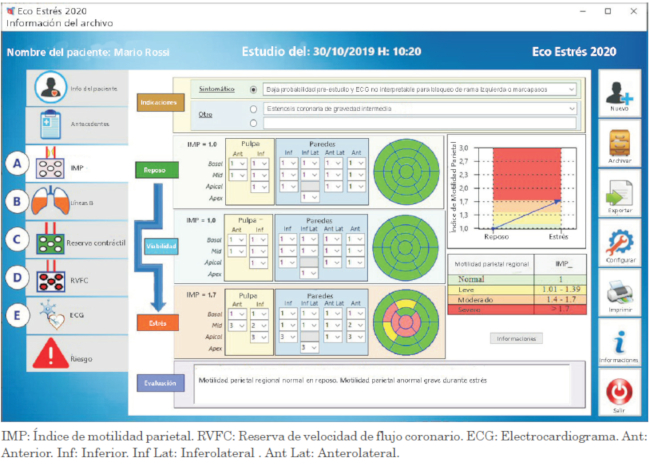 Formulario computarizado de un caso para el análisis de motilidad parietal (fase A). En caso de función de reposo normal, no se contempla la fase de viabilidad (panel central). Se presenta una motilidad parietal normal en reposo (todos los segmentos están codificados en verde). En el pico de estrés, se desarrollan anomalías graves de motilidad regional (codificadas en rojo: discinesia; naranja: acinesia y amarillo: hipocinesia). La gradación de la respuesta se informa en formato tabular (panel derecho superior) y gráfico (panel izquierdo inferior), con valores normales en verde y anormales en amarillo (grado leve), naranja (grado moderado) y rojo (grado grave).