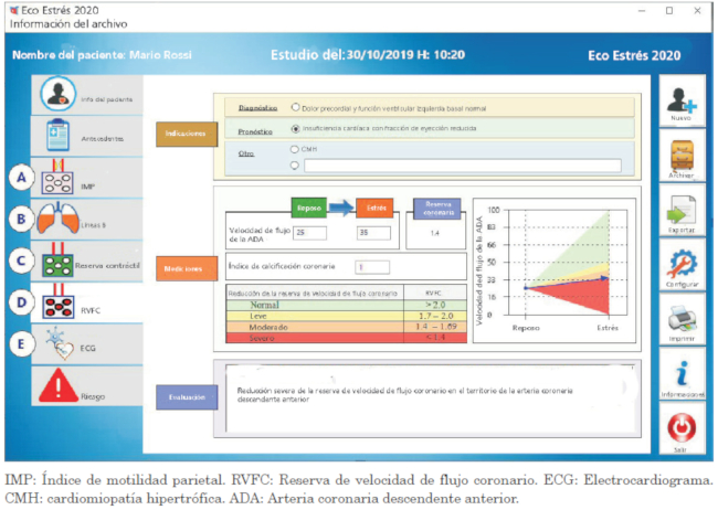 Formulario computarizado de un caso para velocidad de flujo de reserva coronaria (fase D). Los valores de flujo de reserva coronaria se derivan de datos crudos de velocidad de flujo diastólico coronario de reposo y pico. La gradación de la respuesta se informa en formato tabular (panel derecho superior) y gráfico (panel izquierdo inferior), con el mismo código de colores de la Figura 1 (desde verde, normal, a rojo, anomalía grave).
