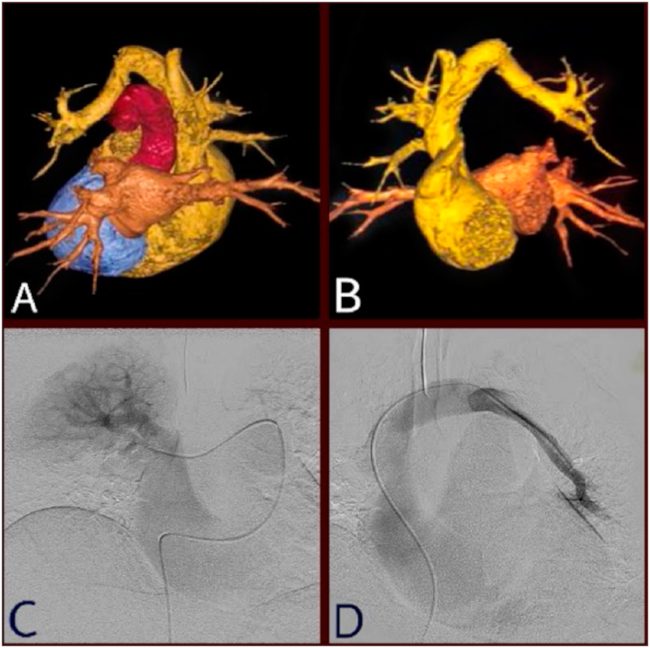 A, B Reconstrucción angiotomográfica de cavidades cardíacas. Angiografía digital de retorno venoso superior pulmonar derecho (C) y superior y língula izquierdo (D).