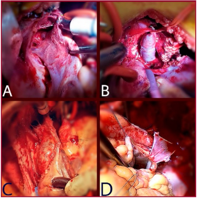 Drenaje anómalo de vena pulmonar superior derecha (A) y vena superior izquierda (B). Tunelización de vena pulmonar superior derecha con parche de pericardio (C) anastomosis de vena superior pulmonar izquierda a orejuela izquierda (D).