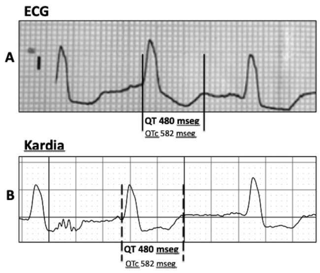 A) Medición de un intervalo QTc prolongado en la derivación D I en un registro electrocardiográfico de superficie. B) Medición mediante registro Kardia Mobile del intervalo QT en el mismo paciente.