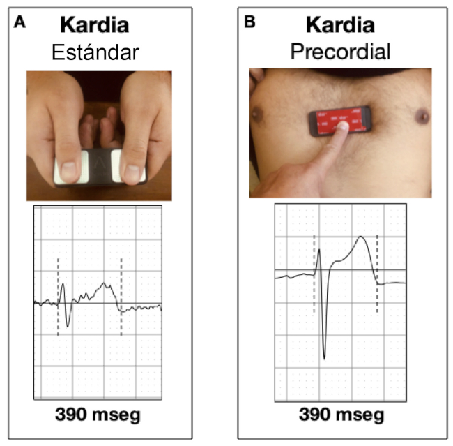 A) Registro estándar tomado con un dispositivo Kardia Movile. B) Registro en el mismo paciente con un dispositivo Kardia Mobile en posición V1-V2 para valoración del intervalo QT.