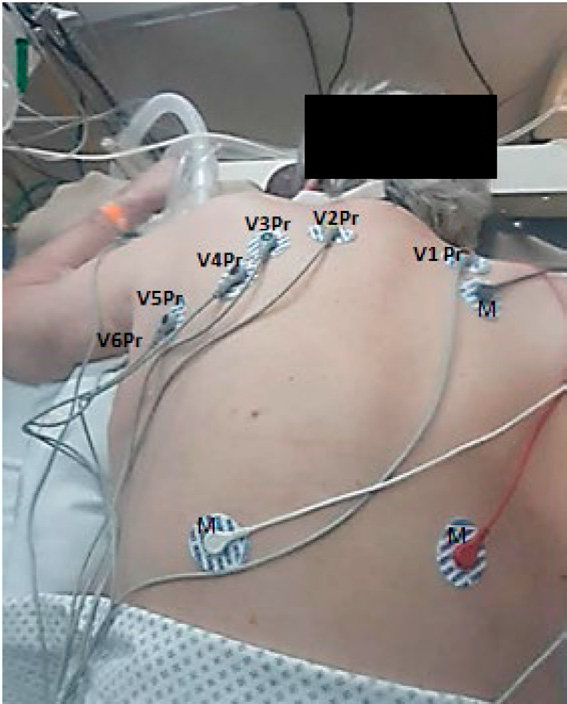 Puede apreciarse la ubicaci&oacute;n de las derivaciones Pr (pronas) de V1Pr a V6Pr. Adicionalmente, en la figura tambi&eacute;n se observan los electrodos de conexi&oacute;n al monitor (M).