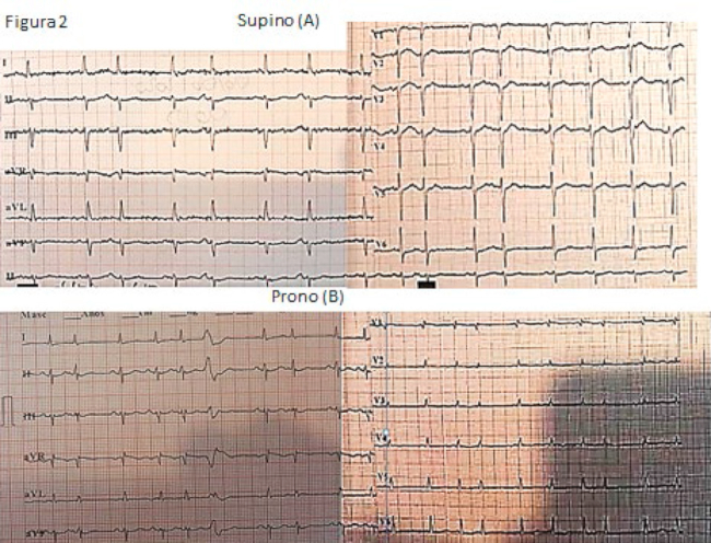 Se observa en A el electrocardiograma obtenido en posici&oacute;n de dec&uacute;bito supino, mientras que en B se muestra el electrocardiograma del mismo paciente en posici&oacute;n de dec&uacute;bito prono.