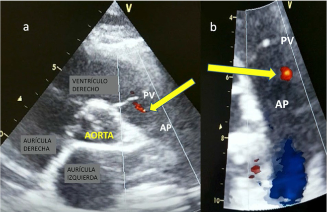 Imagen de ecocardiograma Doppler color. Eje corto grandes vasos (a). La flecha se&ntilde;ala un peque&ntilde;o jet de flujo color sobre el tronco de la arteria pulmonar (AP), se destaca a 4 mm del plano valvular pulmonar (PV), no impresiona reflujo valvular (b).