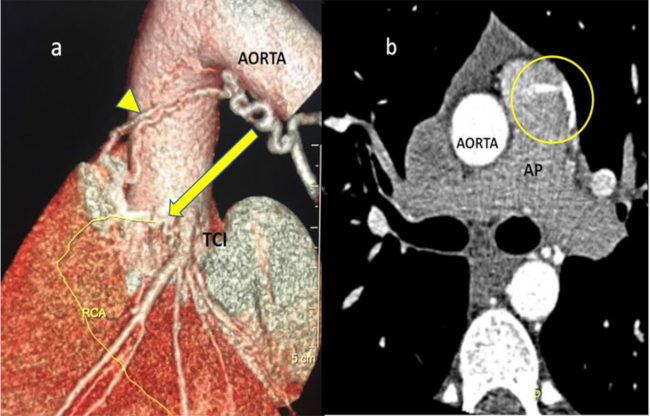 Reconstrucci&oacute;n tridimensional de tomograf&iacute;a card&iacute;aca (a). La flecha se&ntilde;ala sobre el tronco distal (TCI) el origen de una f&iacute;stula coronaria y luego, su anastomosis con una rama bronquial (punta de flecha). Corte tomogr&aacute;fico (b) donde se observa un jet de flujo sobre el tronco de la arteria pulmonar (AP) correspondiente a la desembocadura de la fistula.