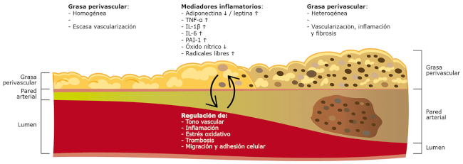 Funci&oacute;n de la grasa perivascular (GPV) en el desarrollo y progresi&oacute;n de la enfermedad coronaria. En el vaso sano, la GPV es homog&eacute;nea, con adipocitos ricos en l&iacute;pidos (escaso l&iacute;quido), escasa vascularizaci&oacute;n y m&iacute;nimas c&eacute;lulas inflamatorias. A medida que se desarrollan las lesiones, la GPV se vuelve heterog&eacute;nea, los adipocitos reducen su tama&ntilde;o en virtud de la disminuci&oacute;n del contenido lip&iacute;dico y de una menor diferenciaci&oacute;n celular, con incremento de la fase acuosa, y se evidencian incremento de la vascularizaci&oacute;n, de c&eacute;lulas inflamatorias (incluida polarizaci&oacute;n de los macr&oacute;fagos hacia una mayor concentraci&oacute;n de macr&oacute;fagos activados, M1), y fibrosis. En cuanto a la &iacute;ntima, se va desarrollando un n&uacute;cleo lip&iacute;dico-necr&oacute;tico con c&eacute;lulas espumosas y microcalcificaciones, y se evidencia adelgazamiento tanto de la media (con remodelamiento coronario positivo) como de la cubierta fibrosa. Estos fen&oacute;menos bidireccionales (desde la pared arterial hacia la GPV, y viceversa) son mediados por m&uacute;ltiples sustancias vasoactivas que regulan el tono vascular, la inflamaci&oacute;n, el estr&eacute;s oxidativo, la coagulaci&oacute;n (PAI-1). IL, interleuquina; TNF, factor de necrosis tumoral; PAI, inhibidor del activador del plasmin&oacute;geno.