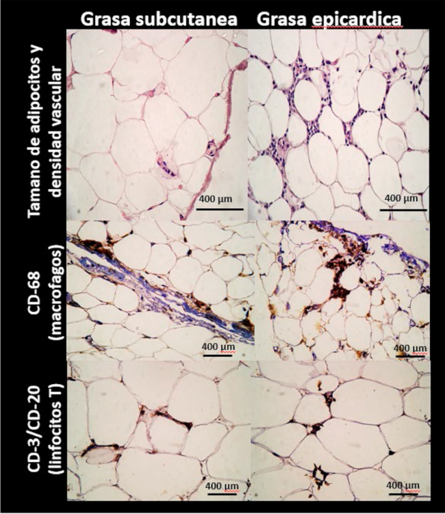 Caracter&iacute;sticas histol&oacute;gicas e infiltrado inflamatorio de tejido adiposo epic&aacute;rdico (regi&oacute;n superior del ventr&iacute;culo derecho) y subcut&aacute;neo (regi&oacute;n tor&aacute;cica) obtenidos de pacientes con enfermedad coronaria derivados a cirug&iacute;a de revascularizaci&oacute;n de miocardio. Los adipocitos del TAE son de menor tama&ntilde;o y el tejido se encuentra m&aacute;s vascularizado que el TAS. Por inmunohistoqu&iacute;mica se comprueba que el TAE presenta infiltrado de macr&oacute;fagos (CD68+) y de linfocitos T (CD 3/ CD20). La tinci&oacute;n marr&oacute;n indica inmunohistoqu&iacute;mica positiva.