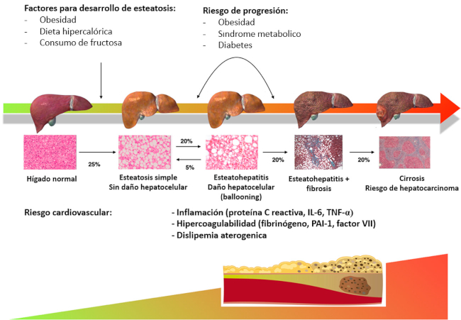 Historia natural del h&iacute;gado graso no alcoh&oacute;lico (HGNA). Se resumen los principales factores de riesgo que condicionan el desarrollo de esteatosis: obesidad, dieta hipercal&oacute;rica y el consumo de fructosa (componente del az&uacute;car y principal componente de jarabe de ma&iacute;z de alta fructosa). Los factores que favorecen el desarrollo de esteatohepatitis, fibrosis y cirrosis son la obesidad, los componentes del s&iacute;ndrome metab&oacute;lico y la diabetes. En el panel inferior, se grafica la relaci&oacute;n entre la progresi&oacute;n del HGNA, la aterog&eacute;nesis y el riesgo de evento cardiovasculares. A medida que progresa la enfermedad hep&aacute;tica aumentan los marcadores de inflamaci&oacute;n, factores procoagulantes y l&iacute;pidos aterog&eacute;nicos que favorecen el desarrollo de ateromatosis y eventos cardiovasculares.